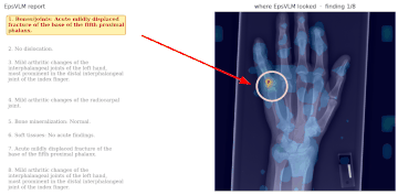 Report-model attention moving across a hand radiograph as each finding is written